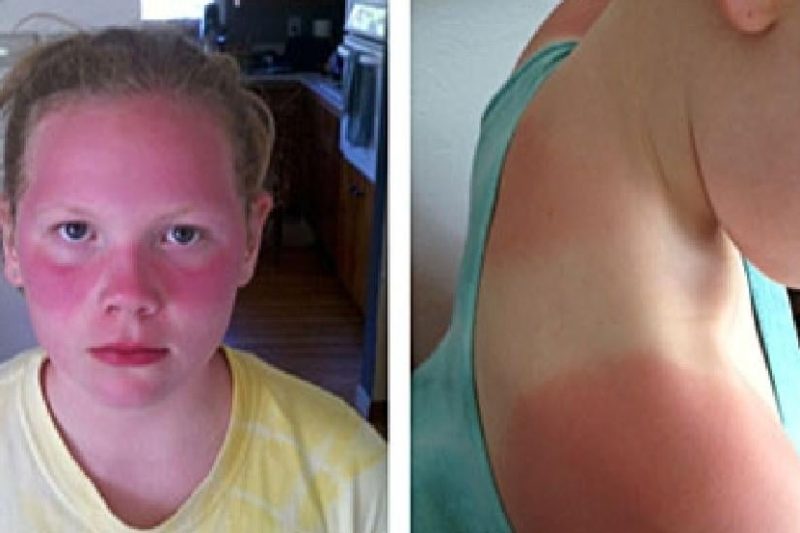 Why Schools Ban Sunscreen but Push Vaccines