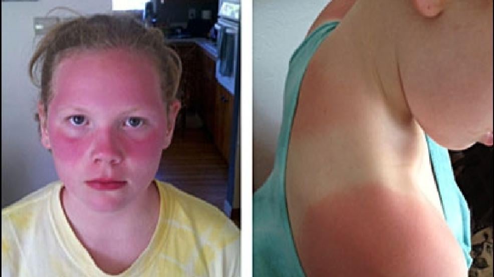Why Schools Ban Sunscreen but Push Vaccines